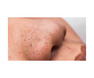 Remove blackheads