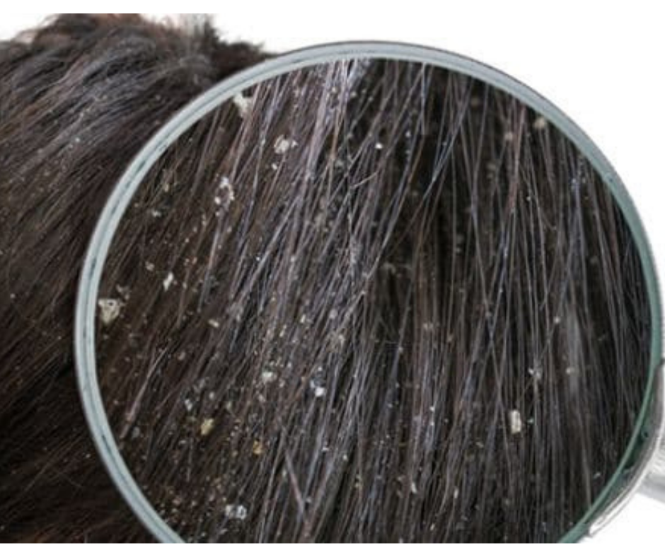 HOW TO GET RID OF DANDRUFF?