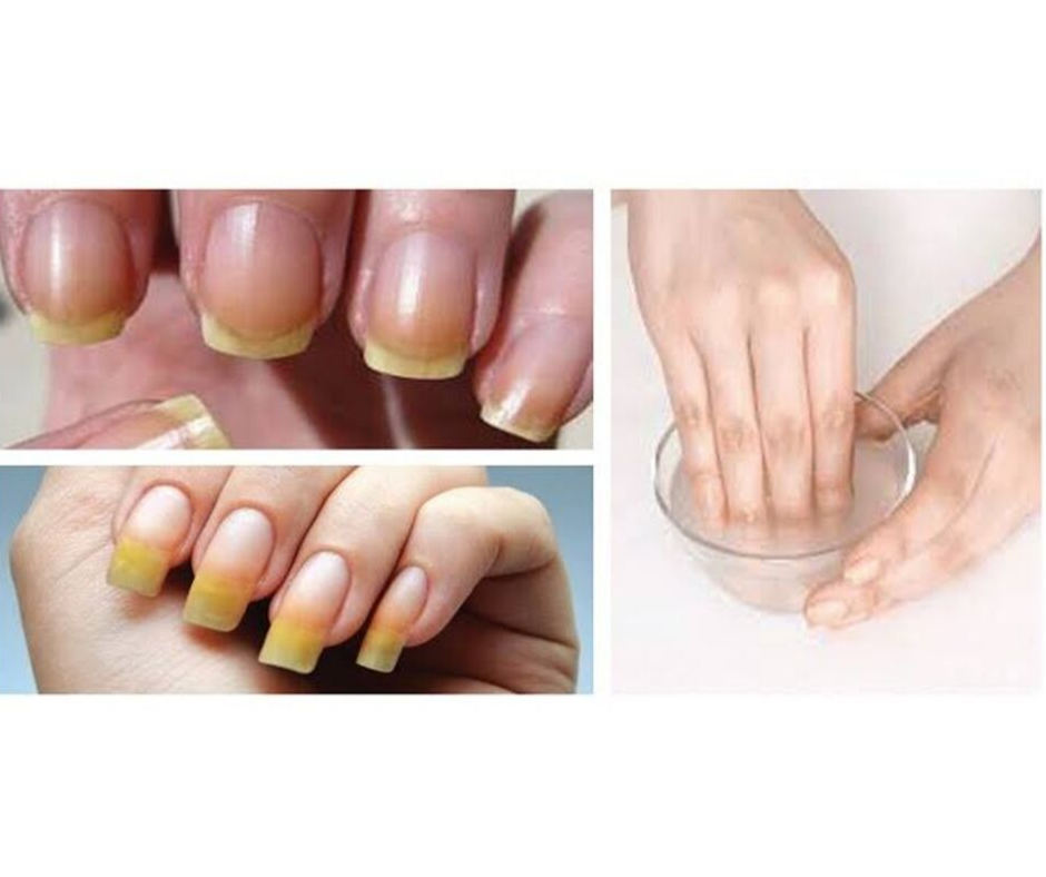 HOME REMEDIES FOR YELLOW NAILS